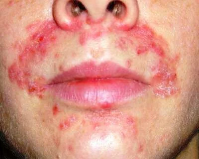 Себорейный дерматит на лице: фото, лечение