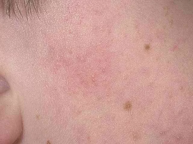 Атопический дерматит у детей - фото 3