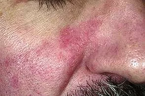 Себорейный дерматит на лице – фото 2