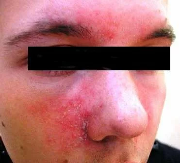 Себорейный дерматит на лице – фото 3