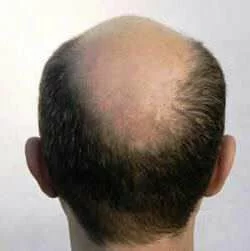 Выпадение волос у мужчин - фото 2