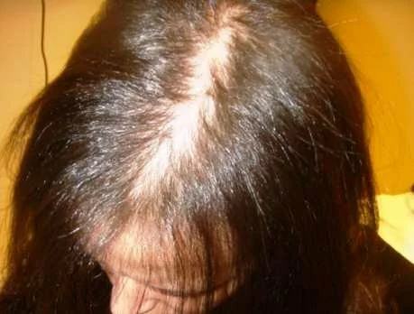 Выпадение волос у женщин - фото 3