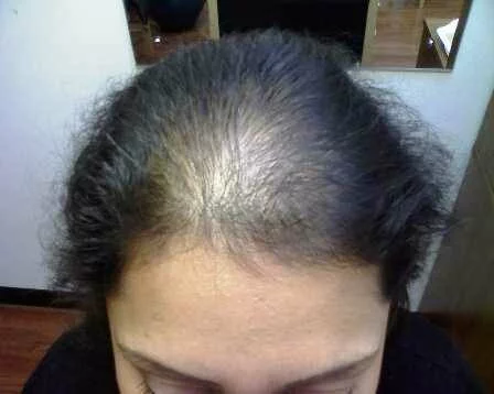 Выпадение волос у женщин - фото 4